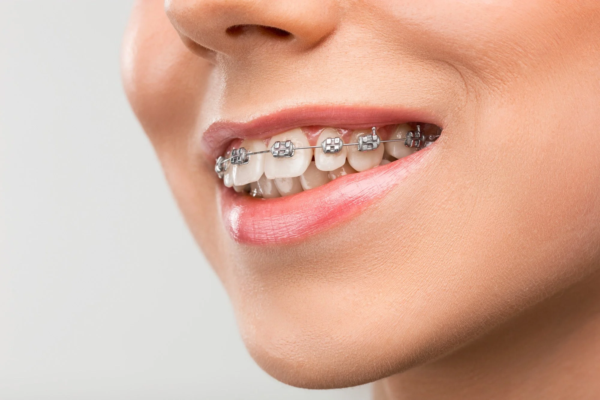 teeth braces cost in gurgaon
