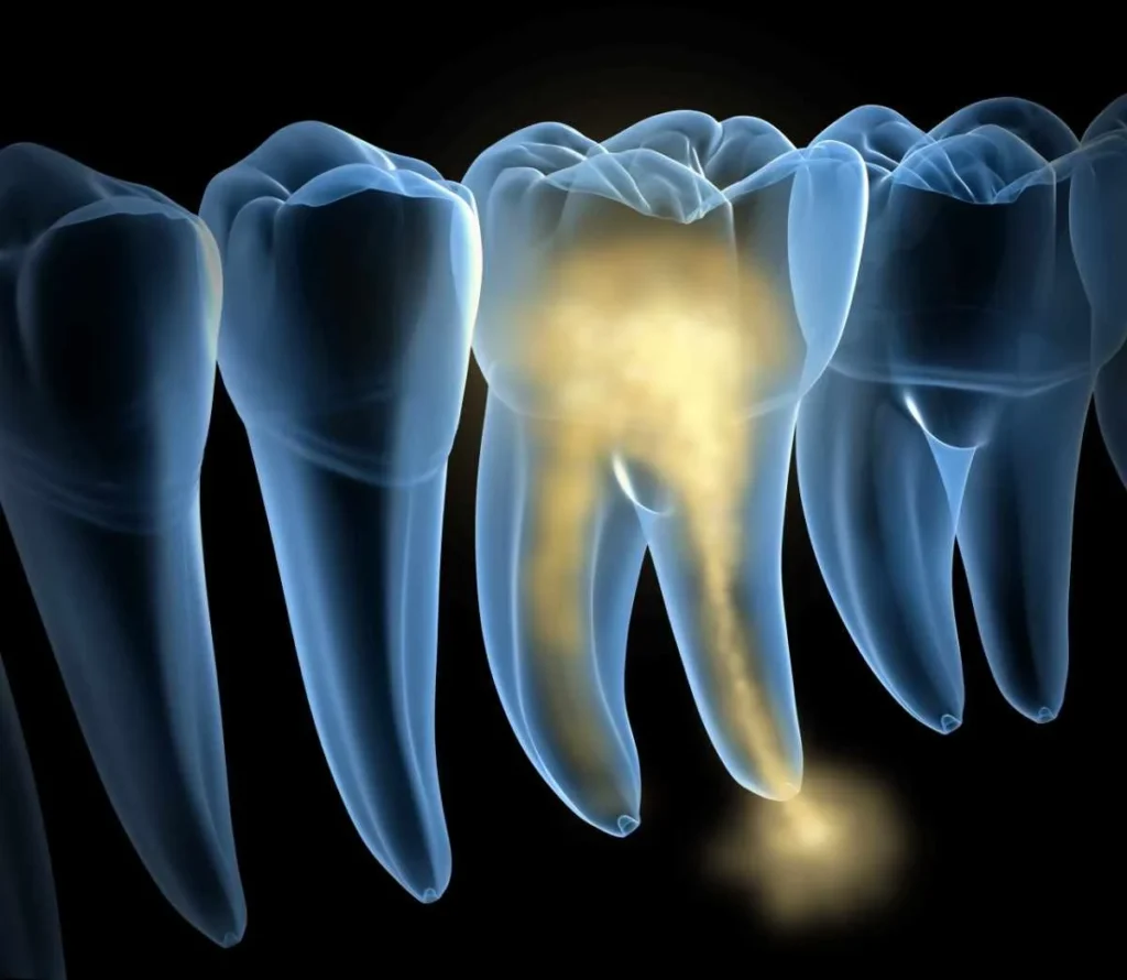Kill Tooth Pain Nerve in 3 Seconds Permanently