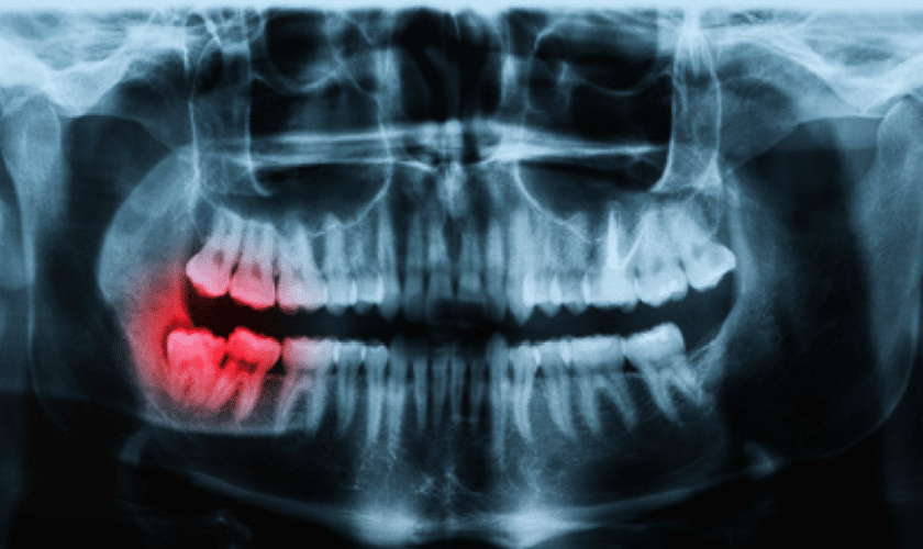 dental xray cost in gurgaon