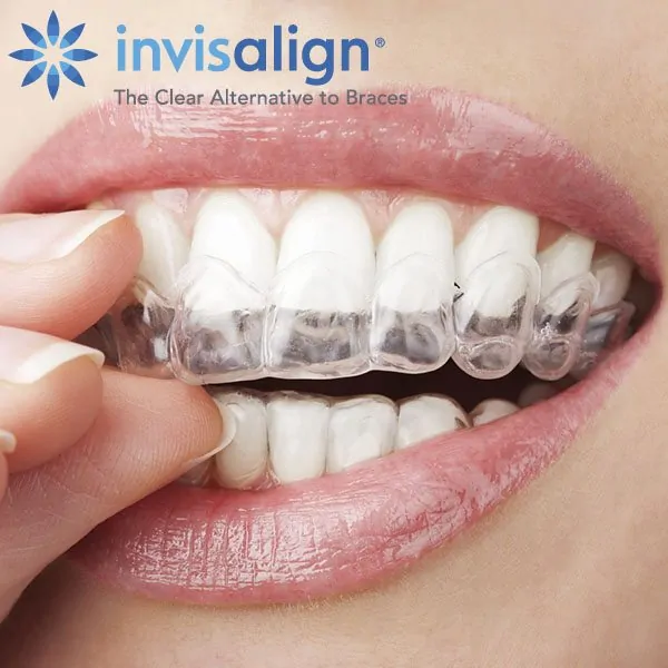 Invisalign Braces Cost in Gurgaon