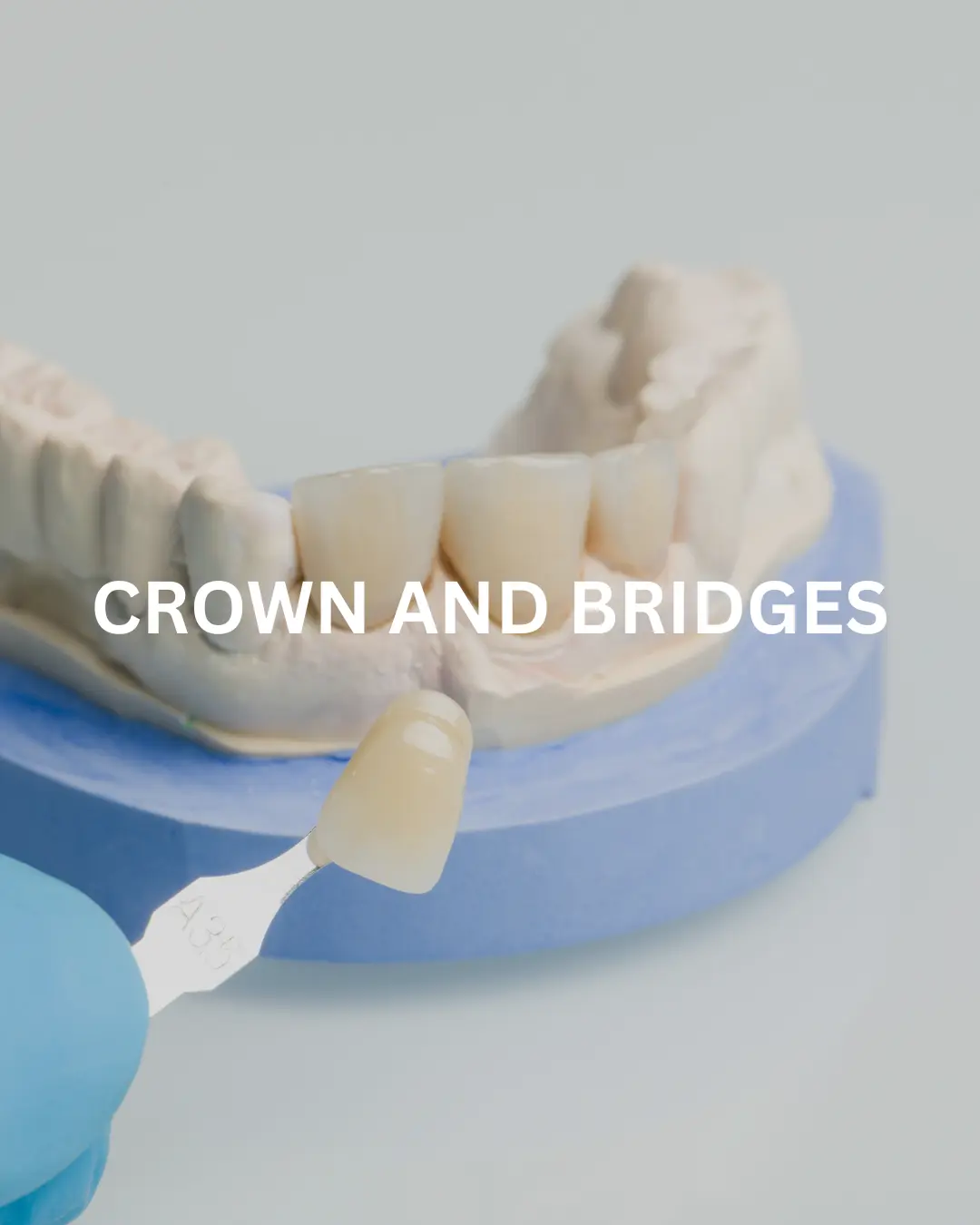 Bridges & Crowns