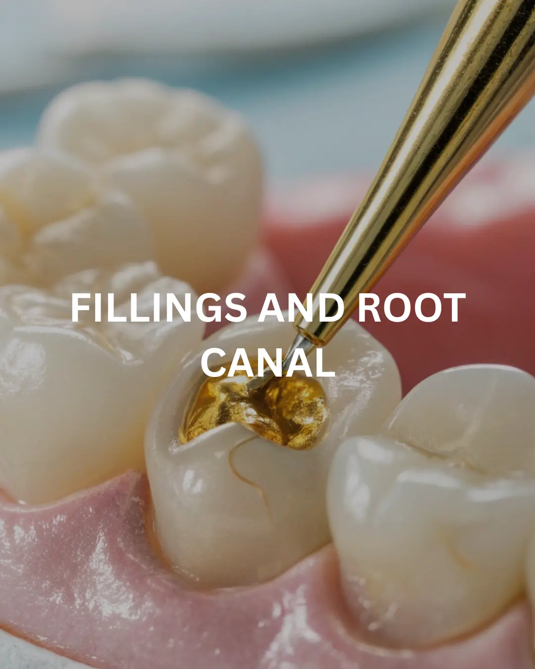 Root Canal & Filling