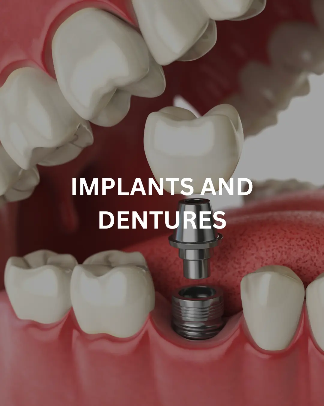 Implants and Dentures